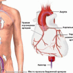 Коронарография – «золотой стандарт» диагностики ишемической болезни сердца
