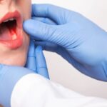 Онкопатология полости рта