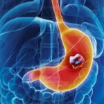 Как защитить желудок от рака