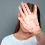 Почему корь опасна для взрослых