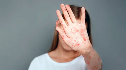 Вакцинация взрослых против кори