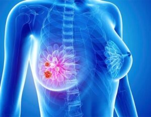 Рак молочной железы