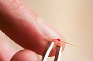 Как вытащить занозу