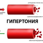 Артериальное давление, что это такое и почему оно повышается?